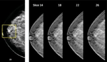 Image: On the left: traditional 2D mammography shows a possible lesion. The four 3D tomosynthesis images to the right show there is no lesion present (Photo courtesy of Hologic).